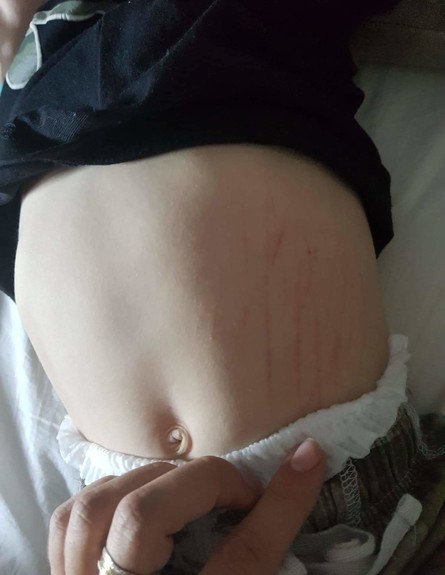 שריטות על הבטן של אחד הילדים מהציפורניים של הגננת המתעללת מאיה דוידוב